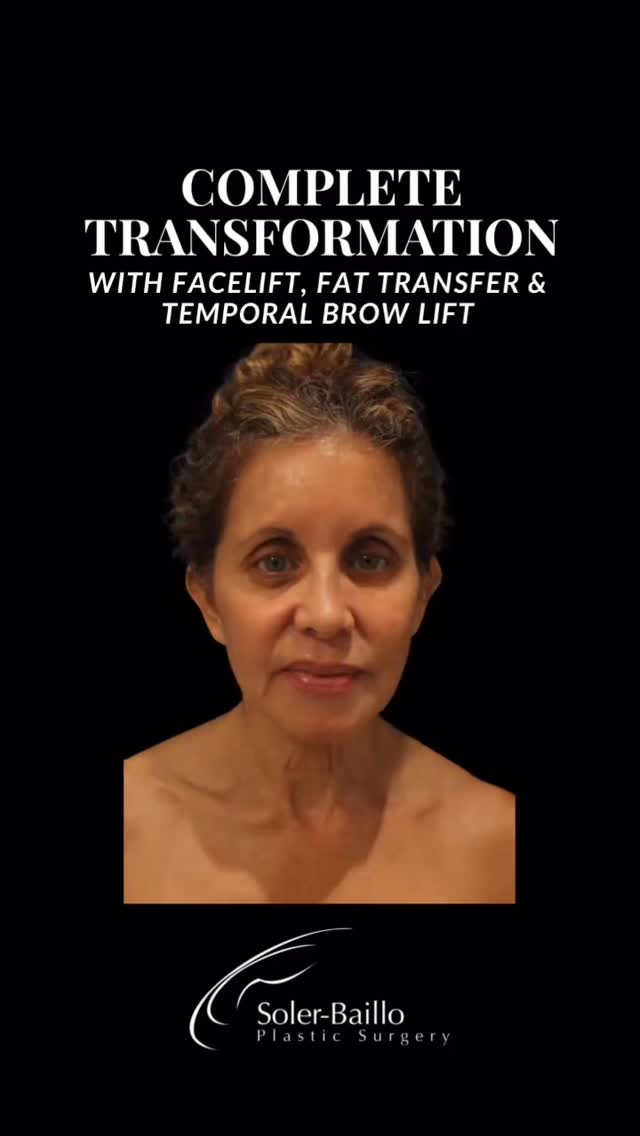 🌹 A complete facial rejuvenation - from the eyes to the jawline.
This patient underwent a customized mini facelift, platysmaplasty, temporal brow lift, upper blepharoplasty, Botox, filler, and targeted fat transfer to the nasolabial folds, tear troughs, and marionette lines.
✨ The result: restored volume, brighter eyes, smoother contours, and a naturally refreshed appearance.
Every detail is tailored by Dr. Soler-Baillo to enhance balance, harmony, and long-lasting rejuvenation.
📩 Contact us to schedule your consultation.
#facialrejuvenation #facelift #blepharoplasty #browlift #fillers #fattransfer