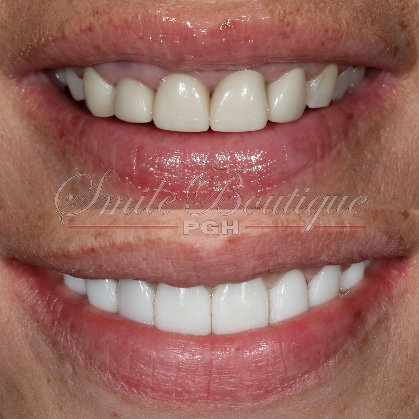 Winning Smile Wednesday 🏆
A gummy smile (too much gums showing when you smile) correction is one of the most rewarding smile transformation that a cosmetic dentist can be apart of. Any of the following conditions below can create a gummy smile look:
1️⃣ Upper jaw over growth
2️⃣ Shortened upper lip
3️⃣ Hyperactive upper lip muscle
4️⃣ Gums overgrowth covering teeth
Depending on which of the above reason(s) is(are) causing a gummy smile, different procedures and/or treatments can be prescribed or done. There isn’t one procedure to treat all gummy smiles.
I had the wonderful privilege to work with this patient who hated her gummy smile and her old ceramic work (ie crowns). In her gummy smile situation, portion to her normal teeth were covered by her excessive gum growth (reason 4️⃣ above) and then her old dentist crowned on the small amount of teeth that was showing which then made all of her teeth short / small look.
With cosmetic dentistry, I can fix her gummy look, but with proper of planning, smile designing, and then extensive amount of revision work. Procedure prescribed and completed were:
☑️ Existing crowns removal
☑️ Gingivoplasty (gum reshape)
☑️ Crown Lengthening (jaw bone trim)
☑️ New crowns & bridges (Lithium Disilicate & Zirconia)
This smile transformation case achieved:
🔸Straighter teeth
🔸Replaced missing teeth
🔸No gum show
🔸Symmetry
🔸Wider smile
🔸Brighter smile
🔸Stronger teeth
🔸Rejuvenated smile
End result = 100% of gum show elimination & a happy smiling patient 🥰 Part 2, we will complete the transformation by addressing to the bottom teeth. Do you have old crowns that are ugly or sticks out? Are you missing teeth where you don’t want to smile or you can chew? Perhaps 2025 is your turn to get a smile that you’ve always wanted. Contact us (link in bio) today to start your smile transformation journey.
#winningsmile #smilemakeover #smiletransformation #gummysmilecorrection #cosmeticdentistry #cosmeticdentist #topdentist #drshieh #toofdocta #luxurylifestyle #treatyourself #porcelainveneers #pittsburgh #pittsburghdentist #wow #beforeandafter #happypatient #wcw #smilemore #sexy #confident #smile